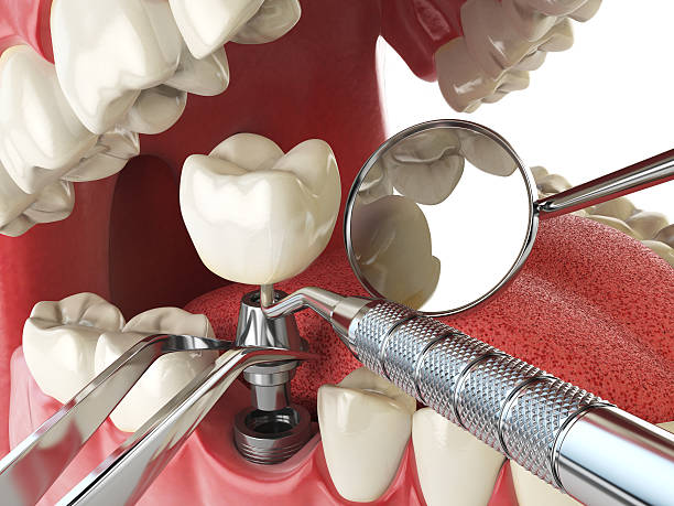 Best Lost Filling or Crown Replacement in Goose Creek Village, VA